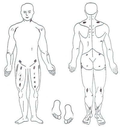 Kartierung nach Dr. St. Amand | Guaifenesin - Selbsthilfe